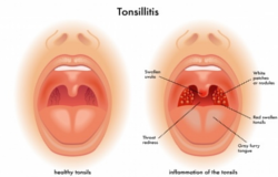 хронический тонзилит