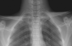 Рентген грудино ключичного сочленения что показывает. 6b23cfaa6d1ae273b9af4aa8cbde1389. Рентген грудино ключичного сочленения что показывает фото. Рентген грудино ключичного сочленения что показывает-6b23cfaa6d1ae273b9af4aa8cbde1389. картинка Рентген грудино ключичного сочленения что показывает. картинка 6b23cfaa6d1ae273b9af4aa8cbde1389. Акромиально-ключичное сочленение – часть плечевого сустава. Благодаря ему осуществляется соединение лопатки с ключицей, что обеспечивает движение рук вверх, двигательные акты в плече. При артрозе акромиально-ключичного сочленения (АКС) происходит дегенеративное изменение тканей, ограничивается функциональность верхних конечностей. Весь патологический процесс сопровождается ухудшением состояния больного, снижением качества жизни. Рентген грудино ключичного сочленения что показывает. 6b23cfaa6d1ae273b9af4aa8cbde1389. Рентген грудино ключичного сочленения что показывает фото. Рентген грудино ключичного сочленения что показывает-6b23cfaa6d1ae273b9af4aa8cbde1389. картинка Рентген грудино ключичного сочленения что показывает. картинка 6b23cfaa6d1ae273b9af4aa8cbde1389. Акромиально-ключичное сочленение – часть плечевого сустава. Благодаря ему осуществляется соединение лопатки с ключицей, что обеспечивает движение рук вверх, двигательные акты в плече. При артрозе акромиально-ключичного сочленения (АКС) происходит дегенеративное изменение тканей, ограничивается функциональность верхних конечностей. Весь патологический процесс сопровождается ухудшением состояния больного, снижением качества жизни.