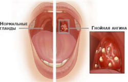 Симптомы кома в горле при шейном остеохондрозе