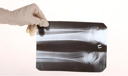 Перелом костей предплечья рентген описание thumbnail