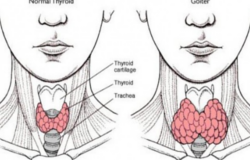 нарушения в работе щитовидной железы