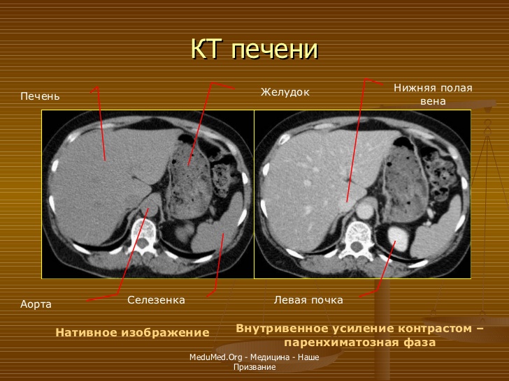 Кт норма печень. Компьютерная томография печени. Цирроз печени на кт с контрастом.